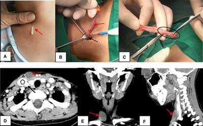 Congenital second branchial cleft anomalies in children: A report of 52 surgical cases, with emphasis on characteristic CT findings